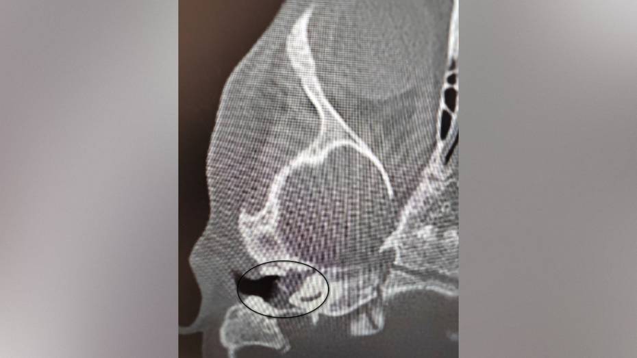 Воронежские врачи вылечили у 2-летнего ребенка редкое заболевание и спасли ему слух