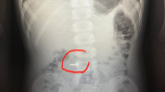 Воронежские врачи показали рентгеновские снимки детей, проглотивших инородные предметы