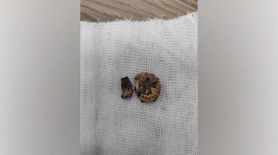 Подросток из Воронежа 5 лет прожил с монетой в носу