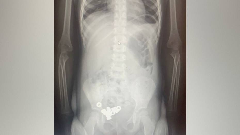 В Воронеже 3-летний малыш проглотил 16 гаек