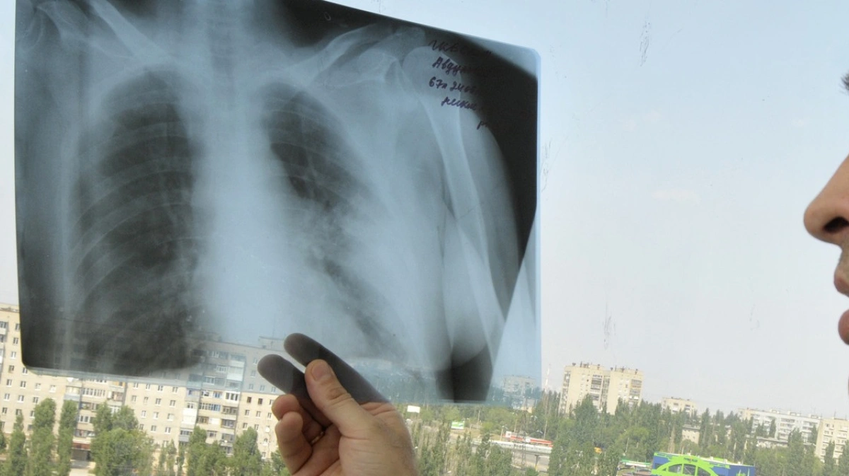Туберкулез в спб. Рентген самый новый. Рентгеновский снимок на термобумаге.