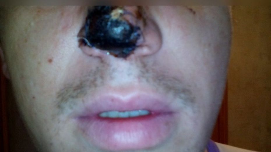 Откусивший нос воронежцу стоматолог впервые видел свою жертву