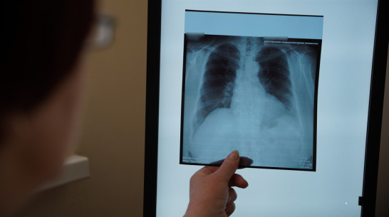 Острогожские рентгенологи и фтизиатры в этом году планируют обследовать на 8 тыс человек больше