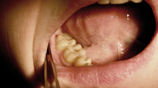Рак полости рта нашли у 140 жителей Воронежской области в 2018 году