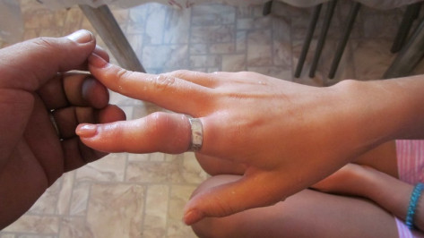 Спасатели помогли жительнице Воронежа снять кольцо