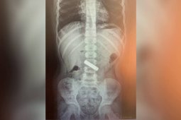 Врачи рассказали, что нашли в желудках и бронхах воронежских детей