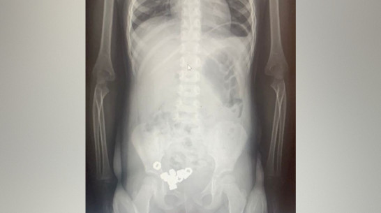 В Воронеже 3-летний малыш проглотил 16 гаек