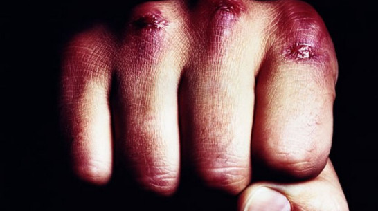 Жителя Лисок дважды за вечер избили и обокрали 