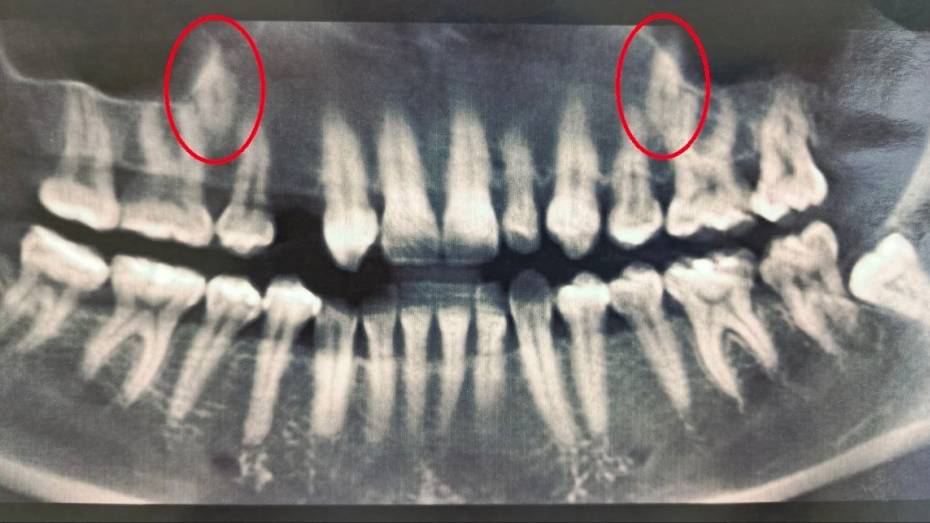 Воронежские стоматологи помогли 38-летней женщине с двумя непрорезавшимися зубами в основном ряду