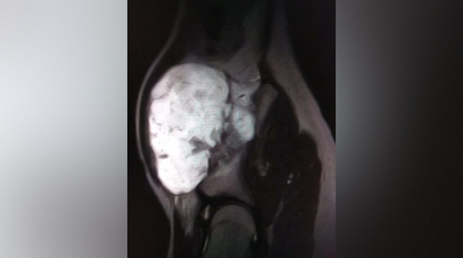 Воронежские врачи удалили подростку большой нарост на кости