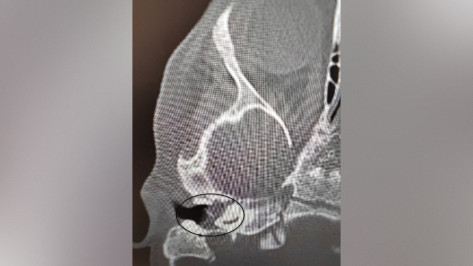 Воронежские врачи вылечили у 2-летнего ребенка редкое заболевание и спасли ему слух