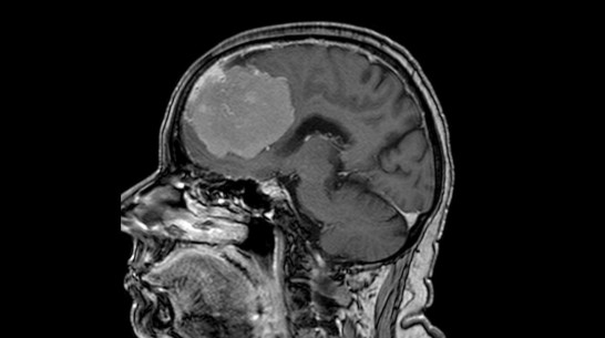 Опухоль размером с грейпфрут удалили из мозга 80-летней жительницы Воронежа