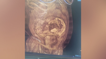 В Воронеже врачи спасли пенсионерку с огромной грыжей, которая 10 лет отказывалась ее лечить