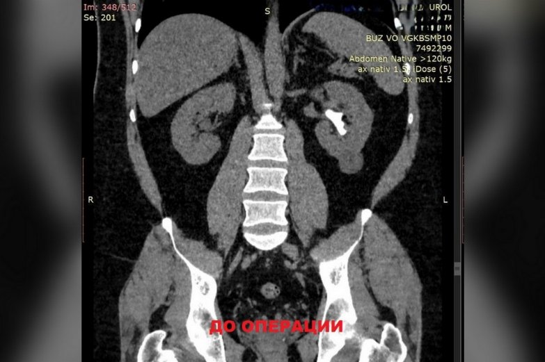 камни в почках