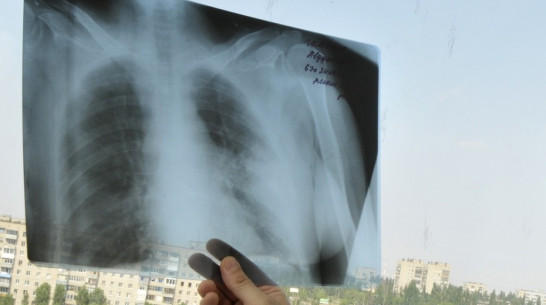 В Каширском районе у двух подростков выявили туберкулез