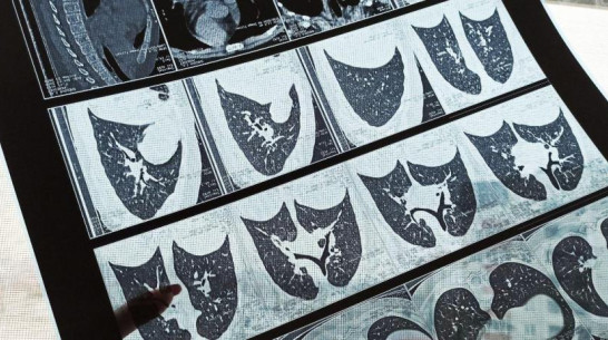 Эксперт Минздрава призвал не делать КТ «на всякий случай»