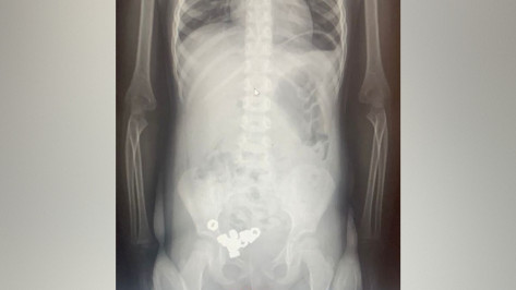 В Воронеже 3-летний малыш проглотил 16 гаек