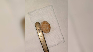 Воронежские врачи извлекли камень из мочевого пузыря 1,5-годовалого ребенка