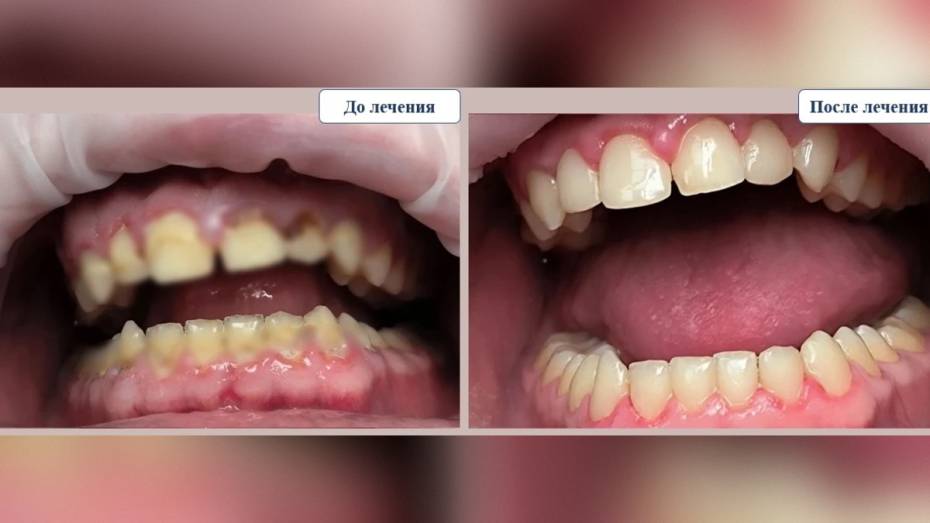 Воронежские стоматологи полгода восстанавливали зубы 21-летнего любителя газировки