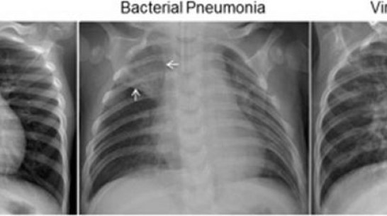 Студент ВГУ разработал программу для определения видов пневмонии