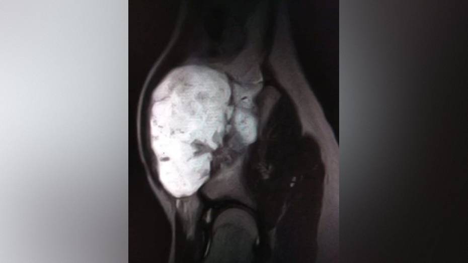 Воронежские врачи удалили подростку большой нарост на кости