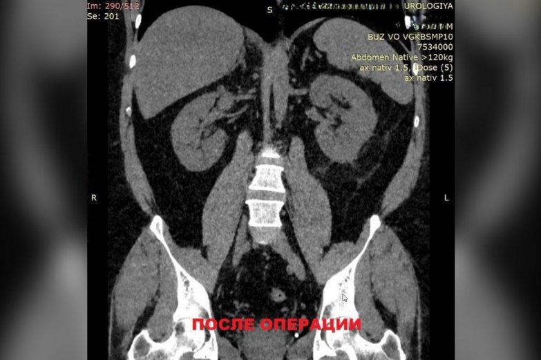 камни в почках