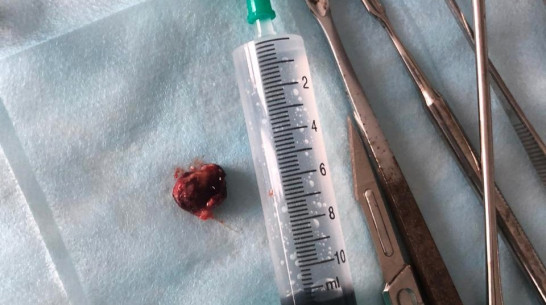 Опухоль из уха пенсионера удалили воронежские врачи