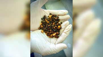 Воронежский хирург показал горсть камней, извлеченных из желчного пузыря пациента