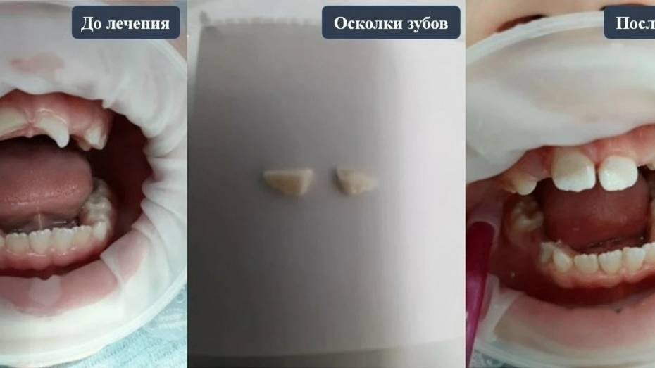 В Воронеже 7-летний ребенок упал с самоката и сломал передние зубы