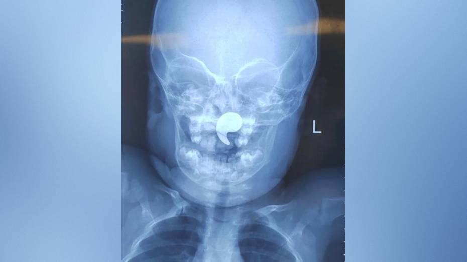 Воронежские врачи достали из носоглотки 1,5-годовалой девочки магнит