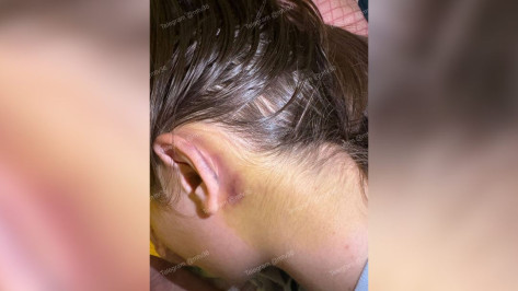 В Воронеже 17-летняя девушка сломала позвоночник во время гонок на картинге