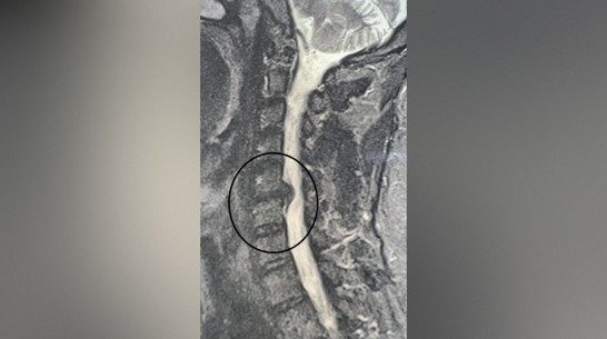 Воронежские врачи удалили пациенту грыжу, которая едва не вызвала паралич руки