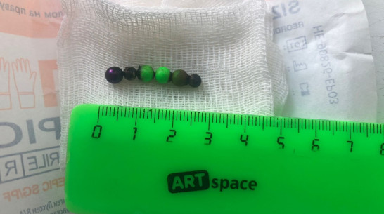 Воронежские врачи спасли 5-летнего ребенка, проглотившего 6 магнитных шариков