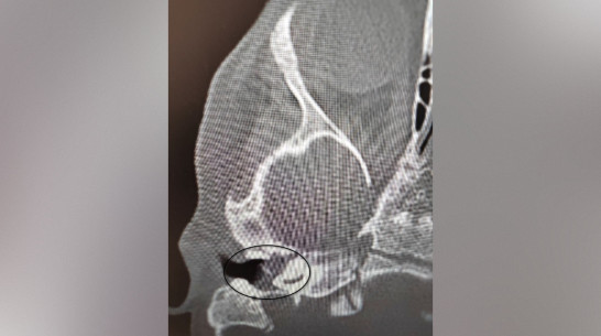 Воронежские врачи вылечили у 2-летнего ребенка редкое заболевание и спасли ему слух