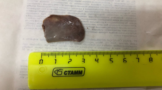 Воронежские врачи спасли ребенка, подавившегося куриной костью