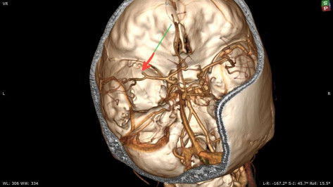 У 35-летней жительницы Воронежа произошел инсульт после стресса на работе