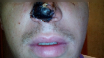 Откусивший нос воронежцу стоматолог впервые видел свою жертву