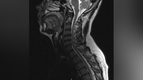 Уникальная операция вернула воронежцу возможность свободно двигать руками